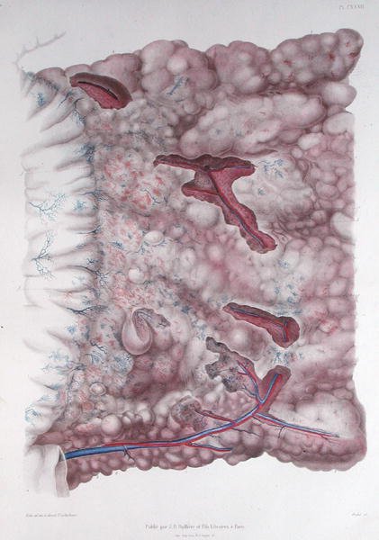 Cancer of the epiploon, fra 