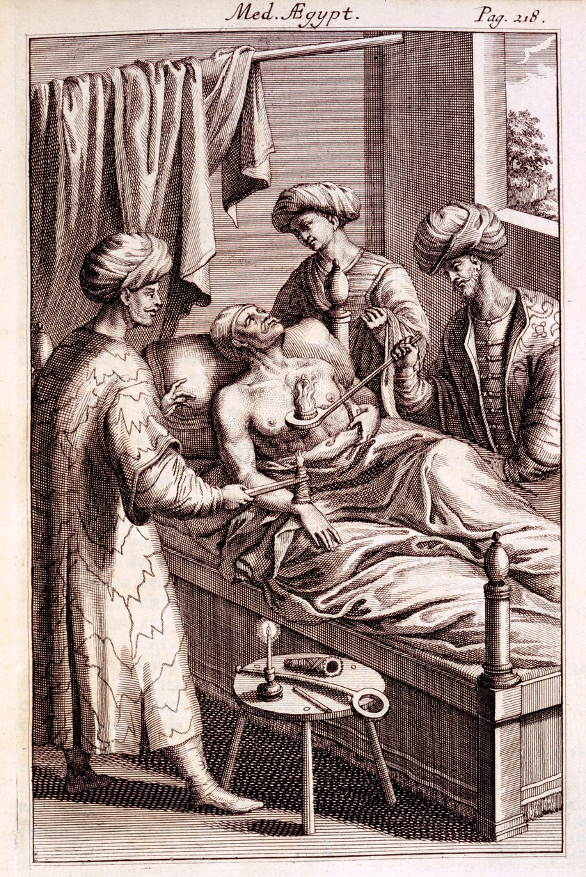 Illustration af moxibustion fra Medicina Aegyptorum af Prospero Alpinus, 1745 af American School