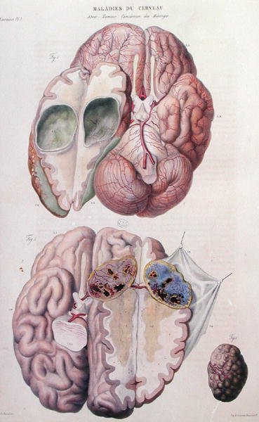 Kræftsvulster i hjernen, fra "Anatomie Pathologique du Corps Humain" af Jean Cruveilhier (1791-1874) 1828-42 (farvestik) af Antoine Chazal