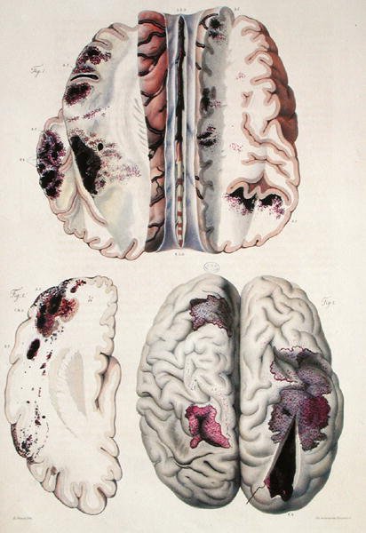 Kapillær apopleksi, fra "Anatomie Pathologique du Corps Humain" af Jean Cruveilhier (1791-1874) 1828-42 (farvestik) af Antoine Chazal