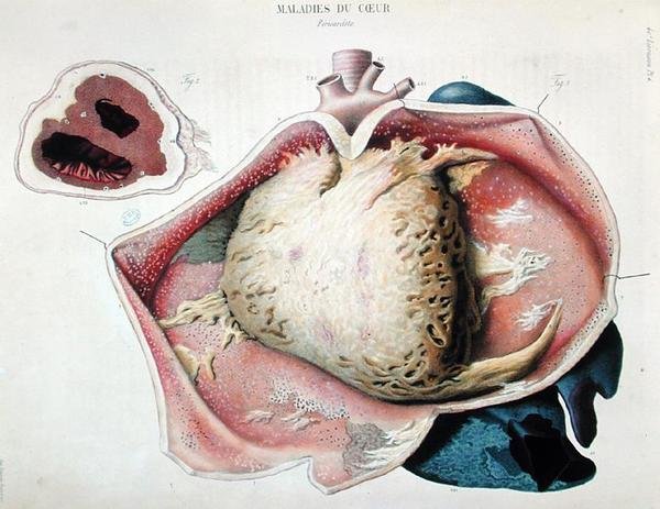Pericarditis, plade med hjertesygdomme fra 