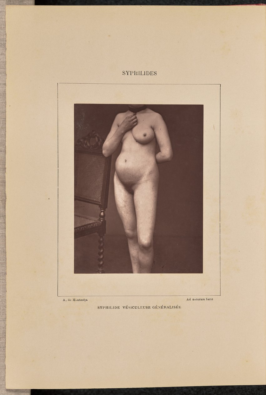 Generaliseret vesikulær syfilis af Arthur de Montmeja