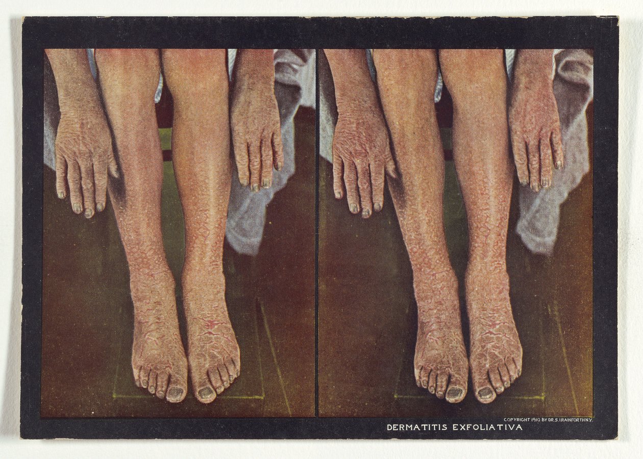 Dermatitis Exfoliativa af Dr. Selden I. Rainforth