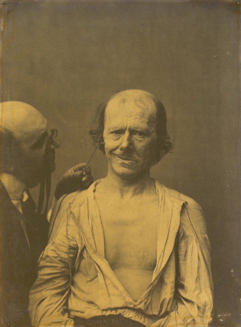 Et afslappet ansigt til venstre, falsk glæde eller latter højre, 1854-1856, trykt 1862. af Duchenne de Boulogne