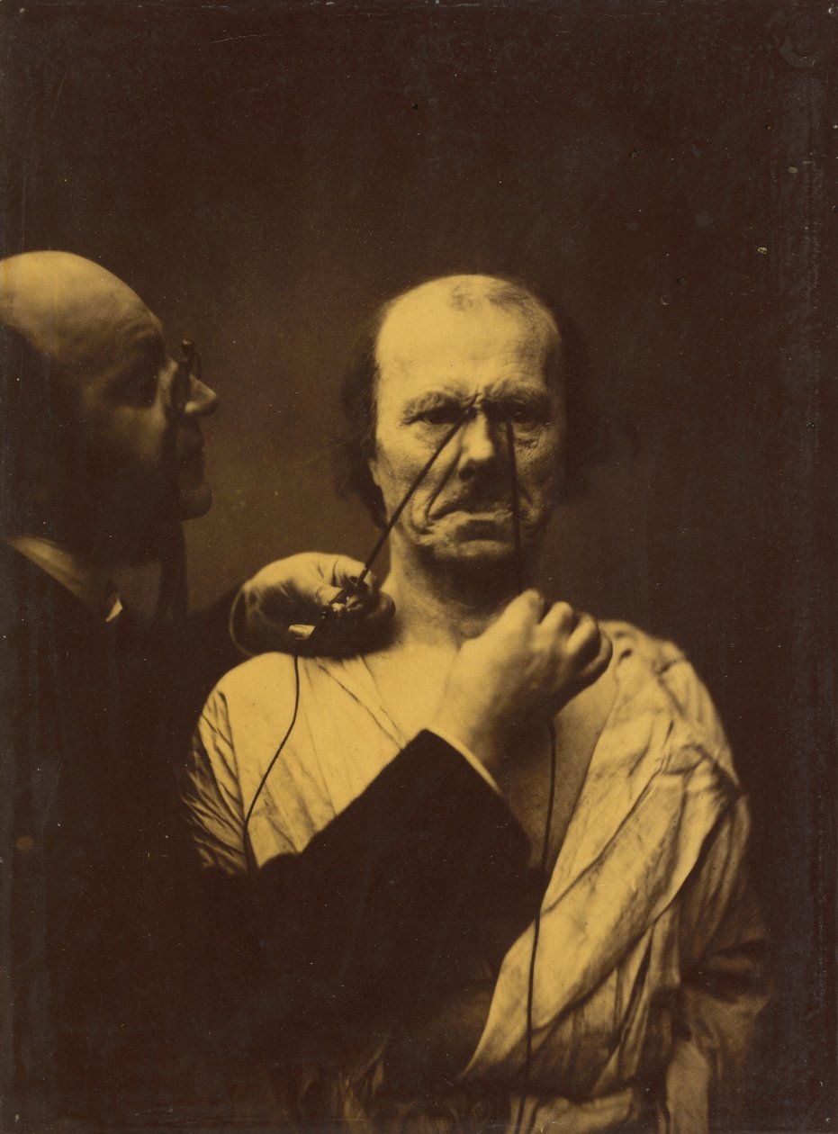Aggression, ondskab, 1854-1856, trykt 1862. af Duchenne de Boulogne