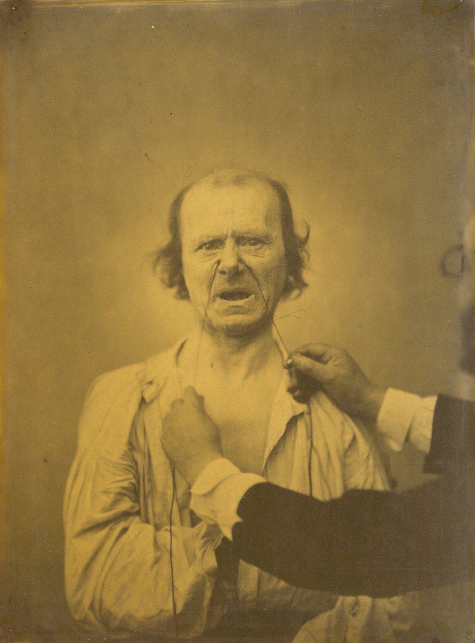 Utilfredshed, dårlig humor, 1854-1856, trykt 1862. af Duchenne de Boulogne