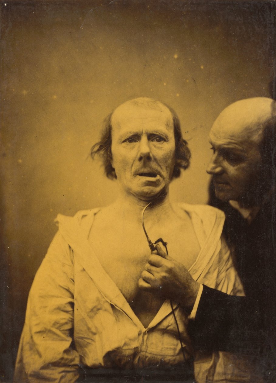 Denne sammentrækning af m. platysma alene mangler udtryk, 1854-1856, trykt 1862. af Duchenne de Boulogne