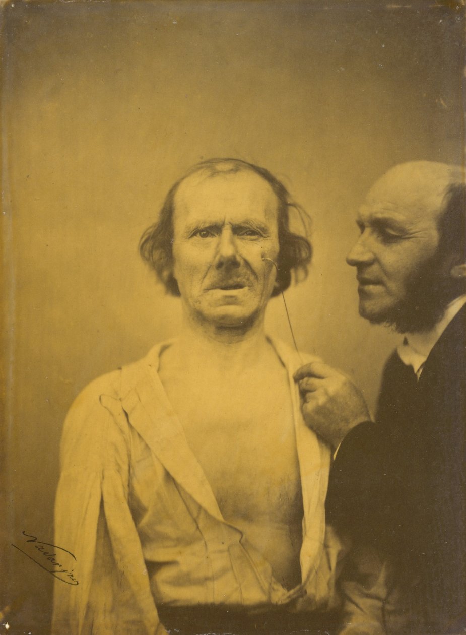 Grædende, medlidenhedstårer venstre, afslappet ansigt til højre, 1854-1856, trykt 1862. af Duchenne de Boulogne