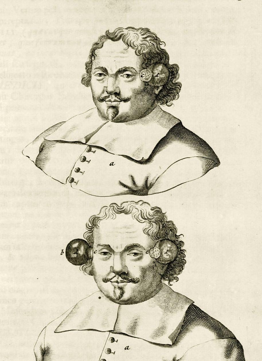 Et eksempel på cupping, fra The Practice of Medicine af Frederik Dekkers, 1694 af Dutch School