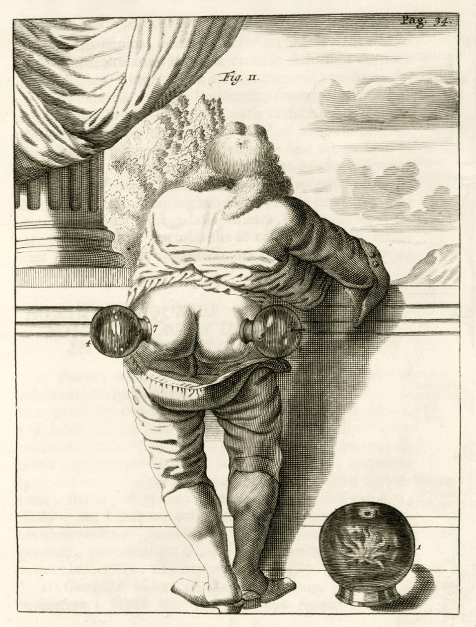 Et eksempel på cupping, fra The Practice of Medicine af Frederik Dekkers, 1694 af Dutch School