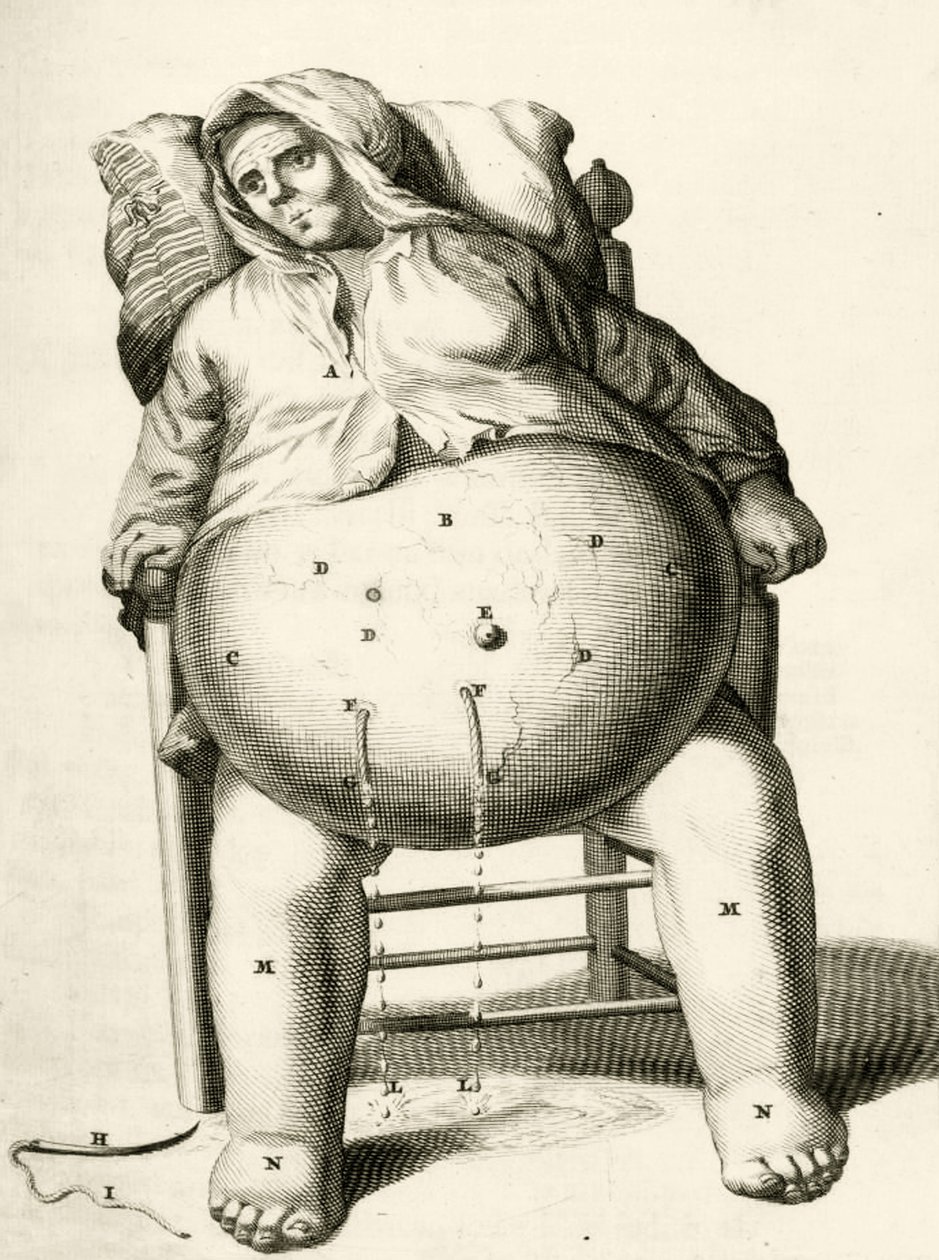 Dræning af væsker fra en byld af Frederik Dekkers, 1694 af Dutch School
