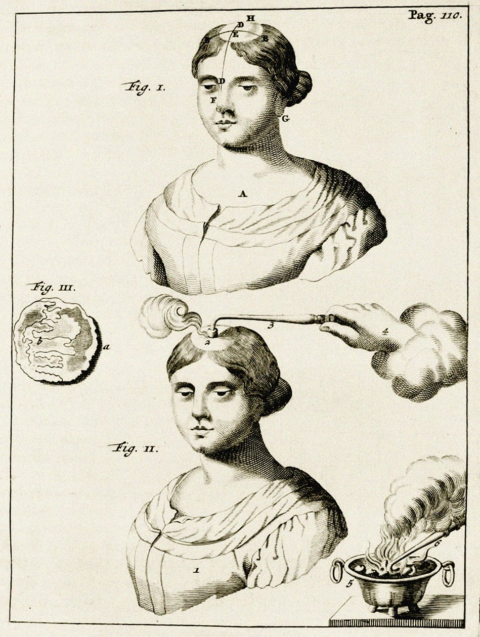 Behandling af en epilepsipatient, fra Øvelser i Lægekunst af Frederik Dekkers, 1694 af Dutch School