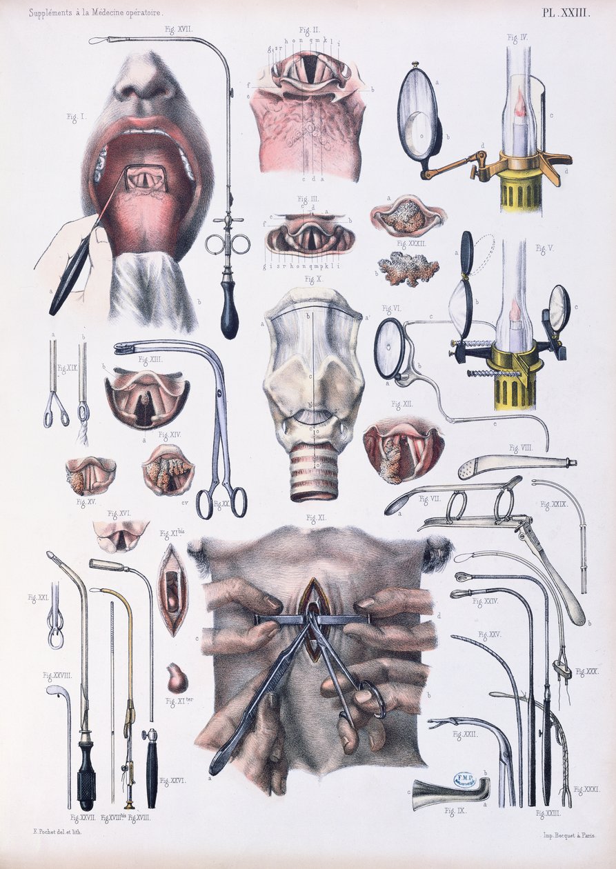 Trakeotomioperation, plade fra 