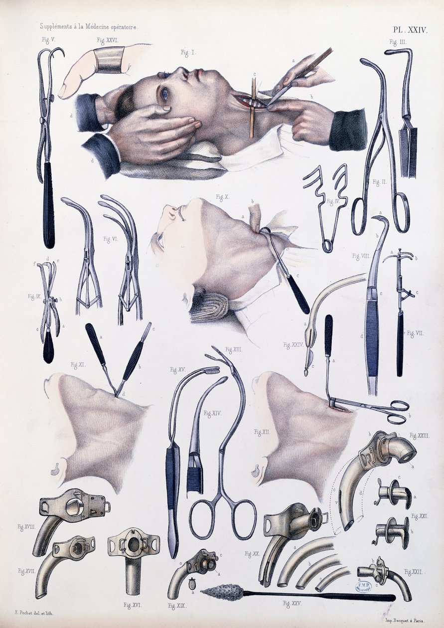 Trakeotomioperation, plade fra 