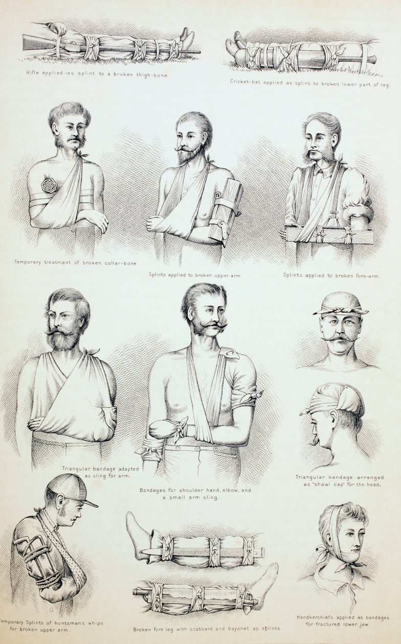 Midlertidig behandling af brud, c.1890 af English School