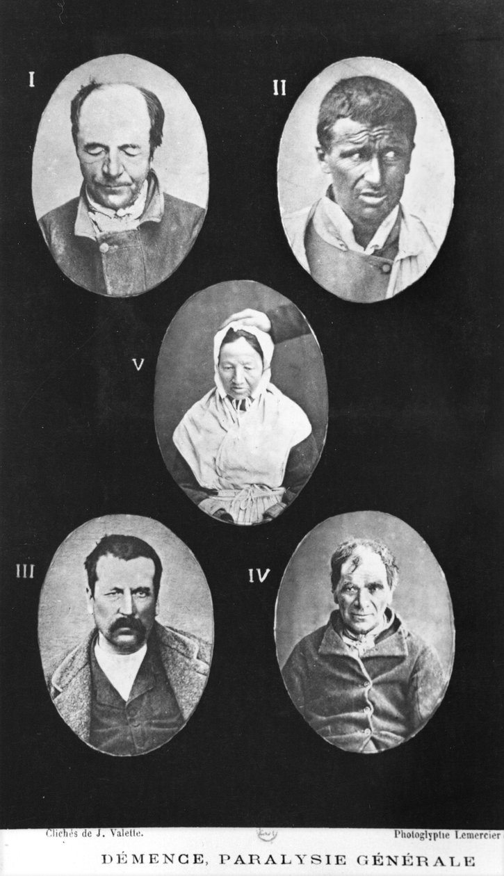 Dementia, General Paralysis, illustration fra Nouveau traite elementaire et pratique des maladies mentales af Henri Dagonet (1823-1902) Paris, Bailliere, 1876 af French Photographer
