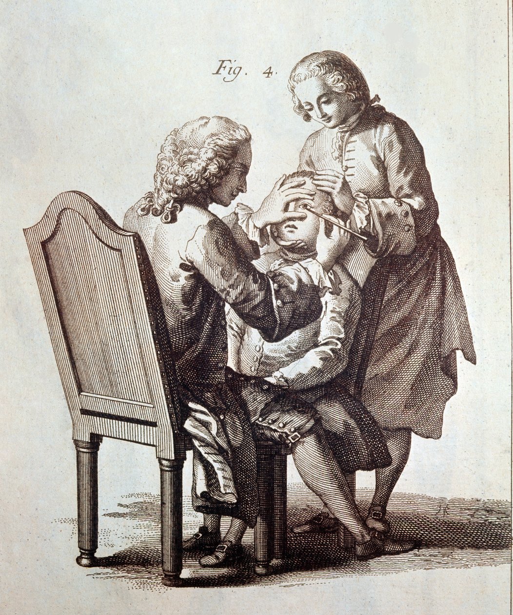 En læge opererer en patient med grå stær, illustration fra Medicinsk Encyklopædi af Denis Diderot og Jean le Rond d