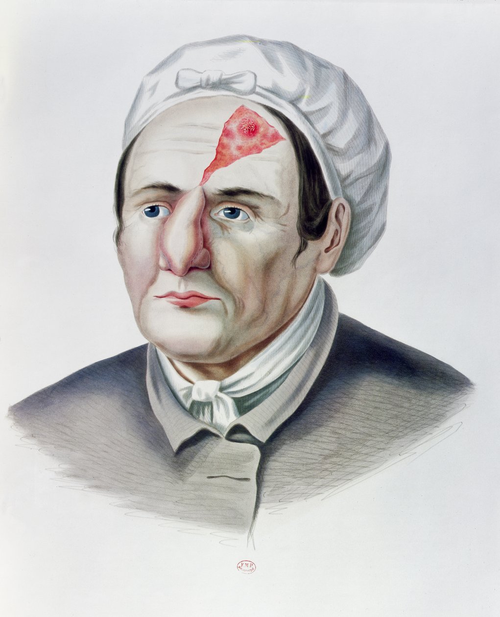 Efter en hudtransplantationsoperation, fra Selecta Praxis Medico-Chirurgica af Alexander Auvert, Paris, 1856 af French School
