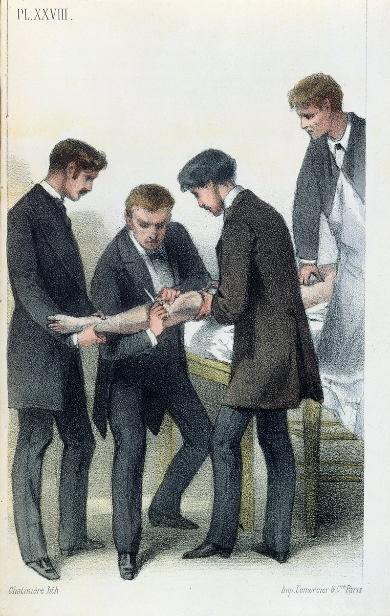 Amputering af en arm, fra en medicinsk manual af Jean-Baptiste-Leon Dubreuil, ca. 1850-60 af French School