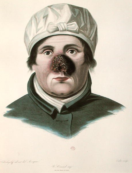 Før en hudtransplantationsoperation, fra 