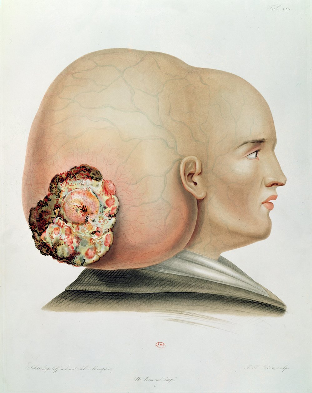 Svamp i dura mater, fra Selecta Praxis Medico-Chirurgica af Alexander Auvert, Paris, 1856 af French School