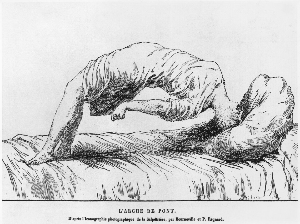 Hysteri og somnambulisme, fra Les Maladies Epidemiques de lEsprit af Paul Regnard (1850-1927) 1884 af French School