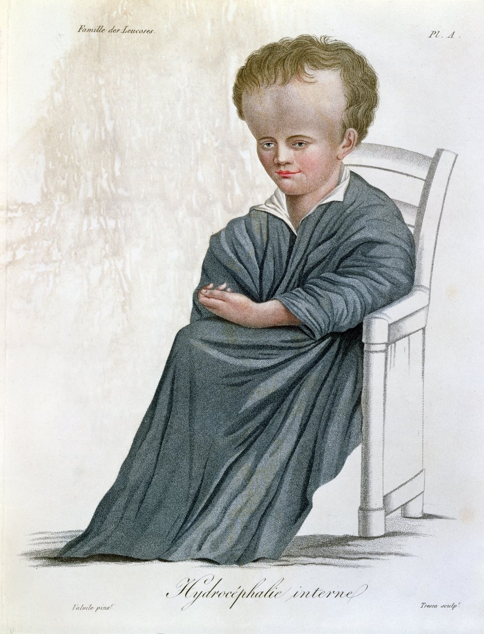 Intern Hydrocephalus, fra Nosologie Naturelle af Baron Jean Louis Alibert (1768-1837) indgraveret af Tresca, 1817 af French School
