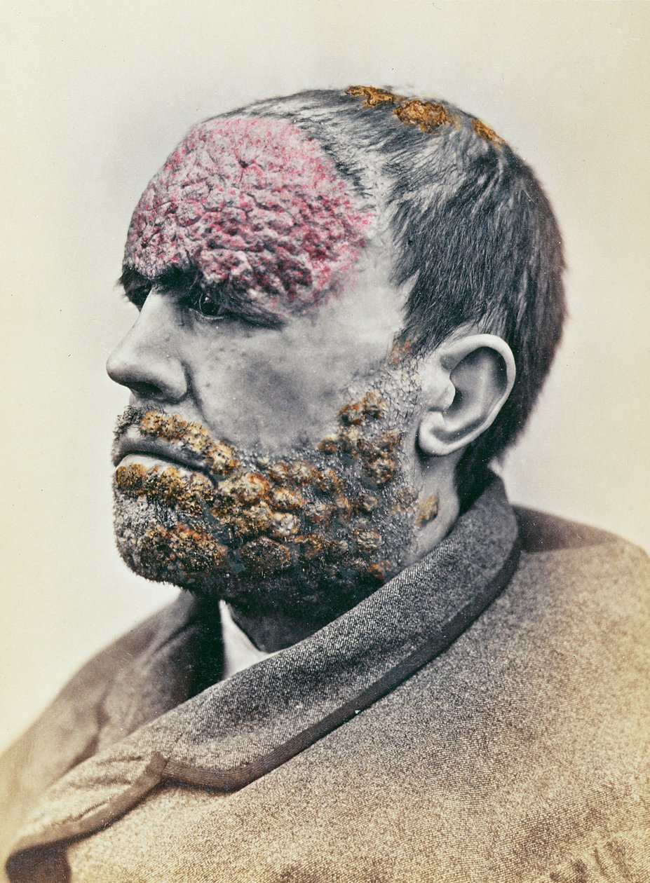 Mand, der lider af syfilis, fra et fotografi taget til Clinique Photographique de lHopital Saint-Louis, 1868 af French School