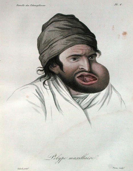 Maxillær polyp, fra en bog af Baron Jean Louis Alibert (1768-1837) 1817 (farvet gravering) af French School
