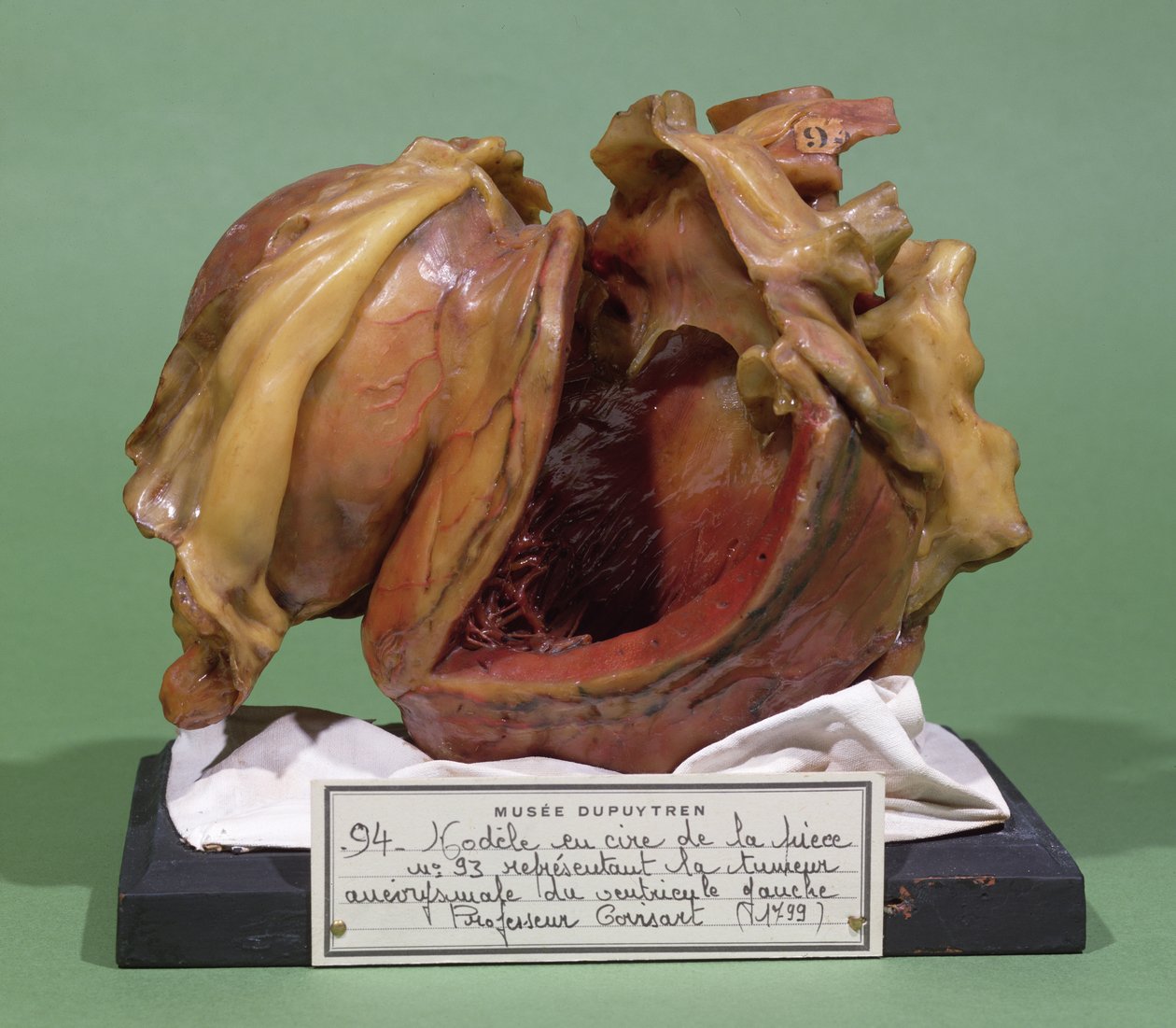 Model af en tumor i venstre ventrikel, 1799 (voks) af French School