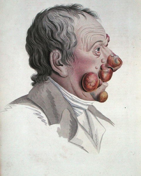 Mycosis Fongoide, fra en bog af Baron Jean Louis Alibert (1768-1837) 1838 (farvet gravering) af French School