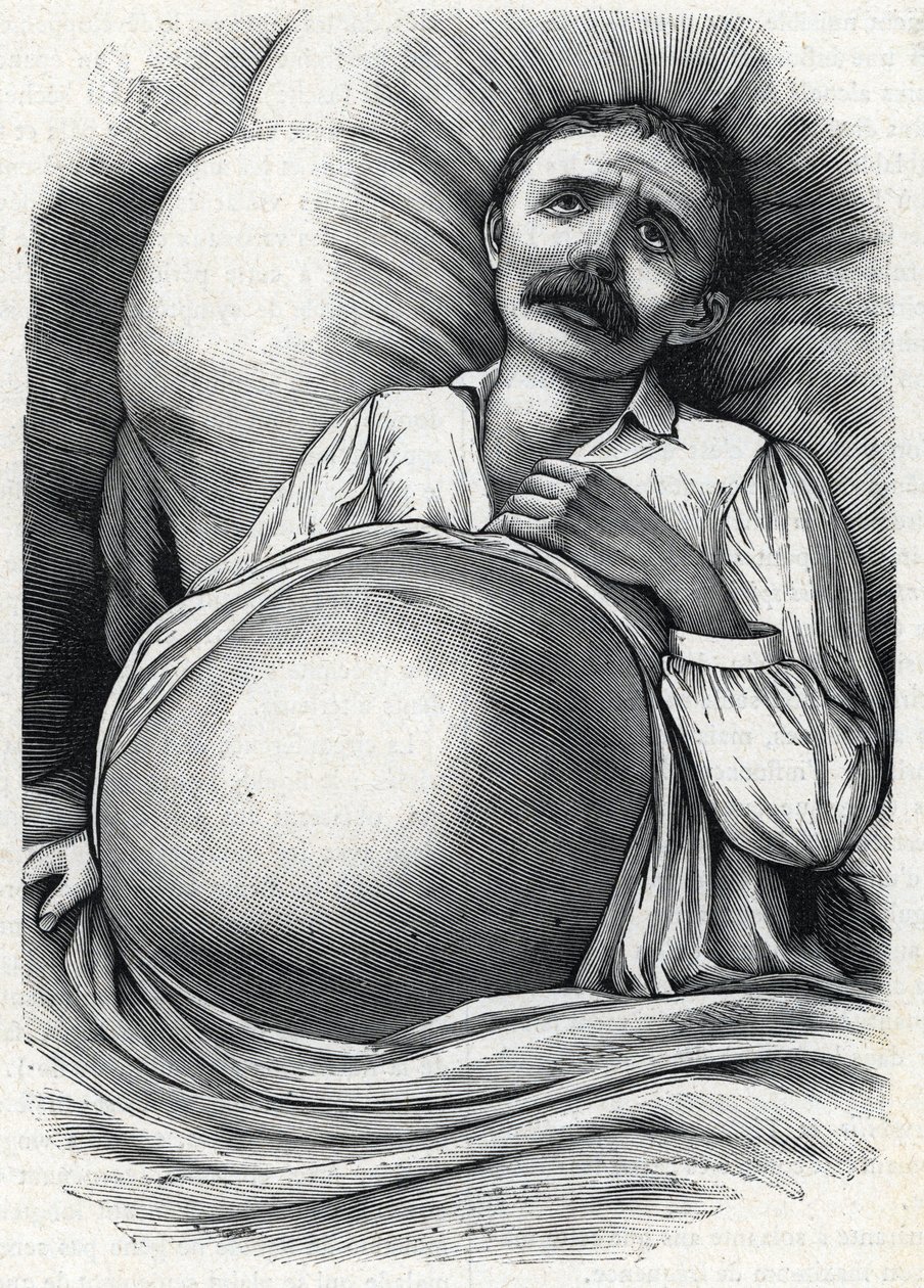 Patient med fremskreden levercirrhose (gravering) 1888 af French School