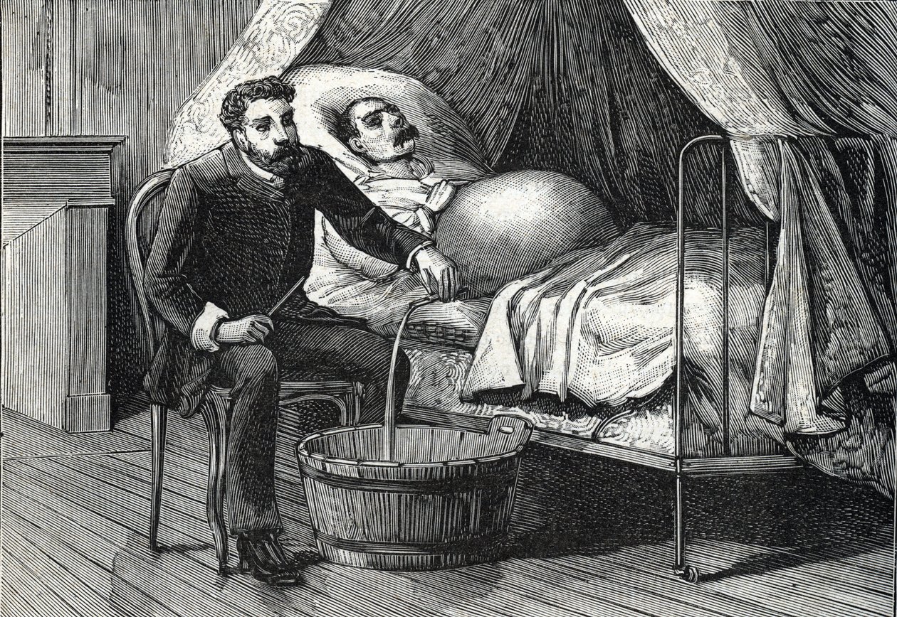 Patient med fremskreden levercirrhose, læge, der udfører en punktering (gravering) 1888 af French School