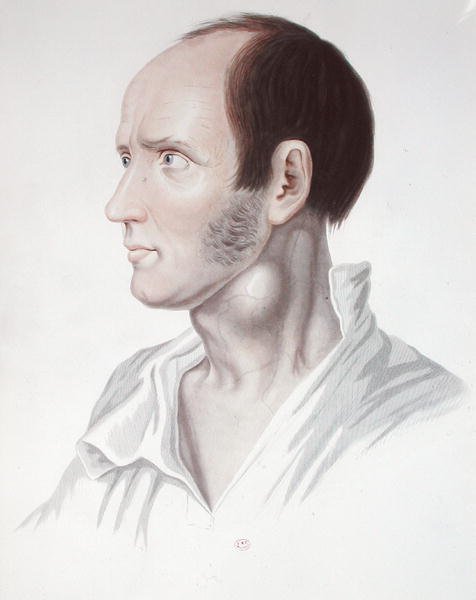 Patient med aneurisme, fra 