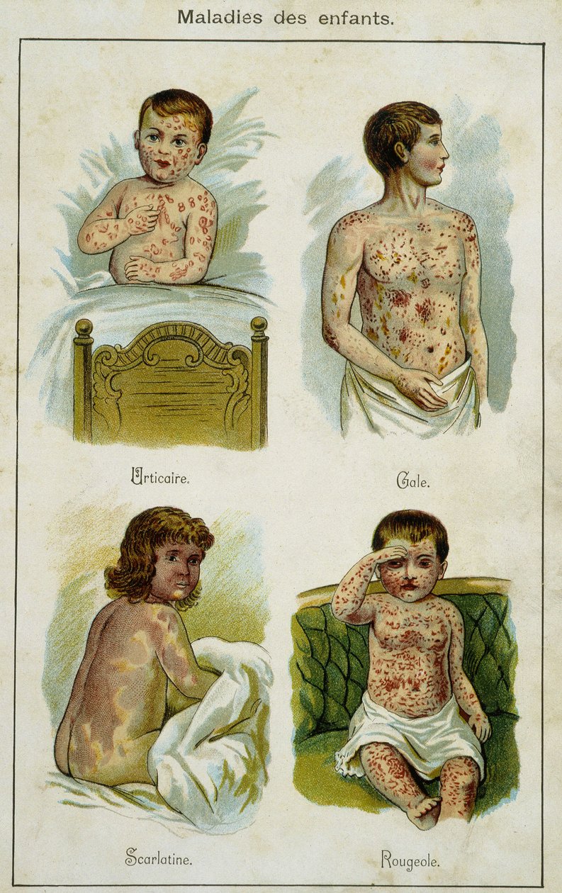 Plade, der illustrerer børns sygdomme: nældefeber, fnat, skarlagensfeber og mæslinger (udtræk fra Bilz, naturlig medicin) sidst i det 19. århundrede. af French School