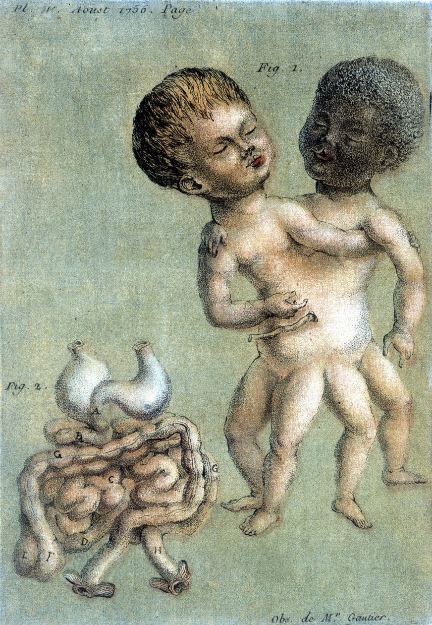 Plade med medicin, der repræsenterer siamesiske brødre: en hvid og en sort. illustration af Toussaint (1756) i "Periodic Observations on Physics, Natural History and the Arts". af French School