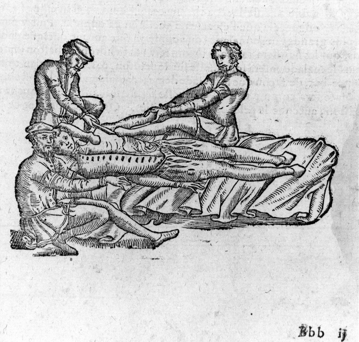 Reduktion af en dislokation, -i "Medical Treatise of Ambroise Paré", omkring 1560. af French School