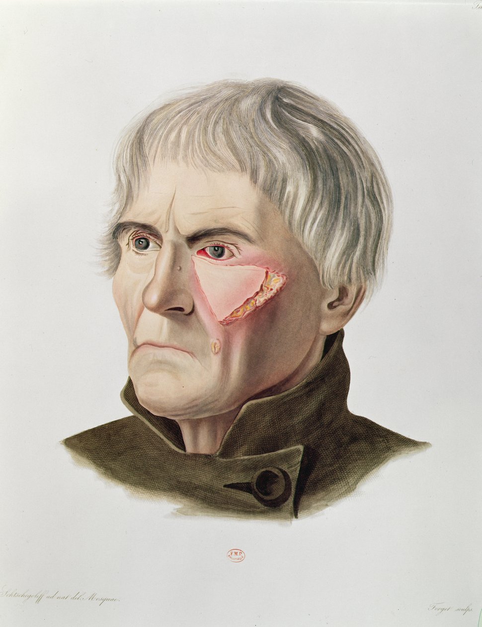 Hudtransplantation, fra Selecta Praxis Medico-Chirurgica af Alexander Auvert, Paris, 1856 af French School