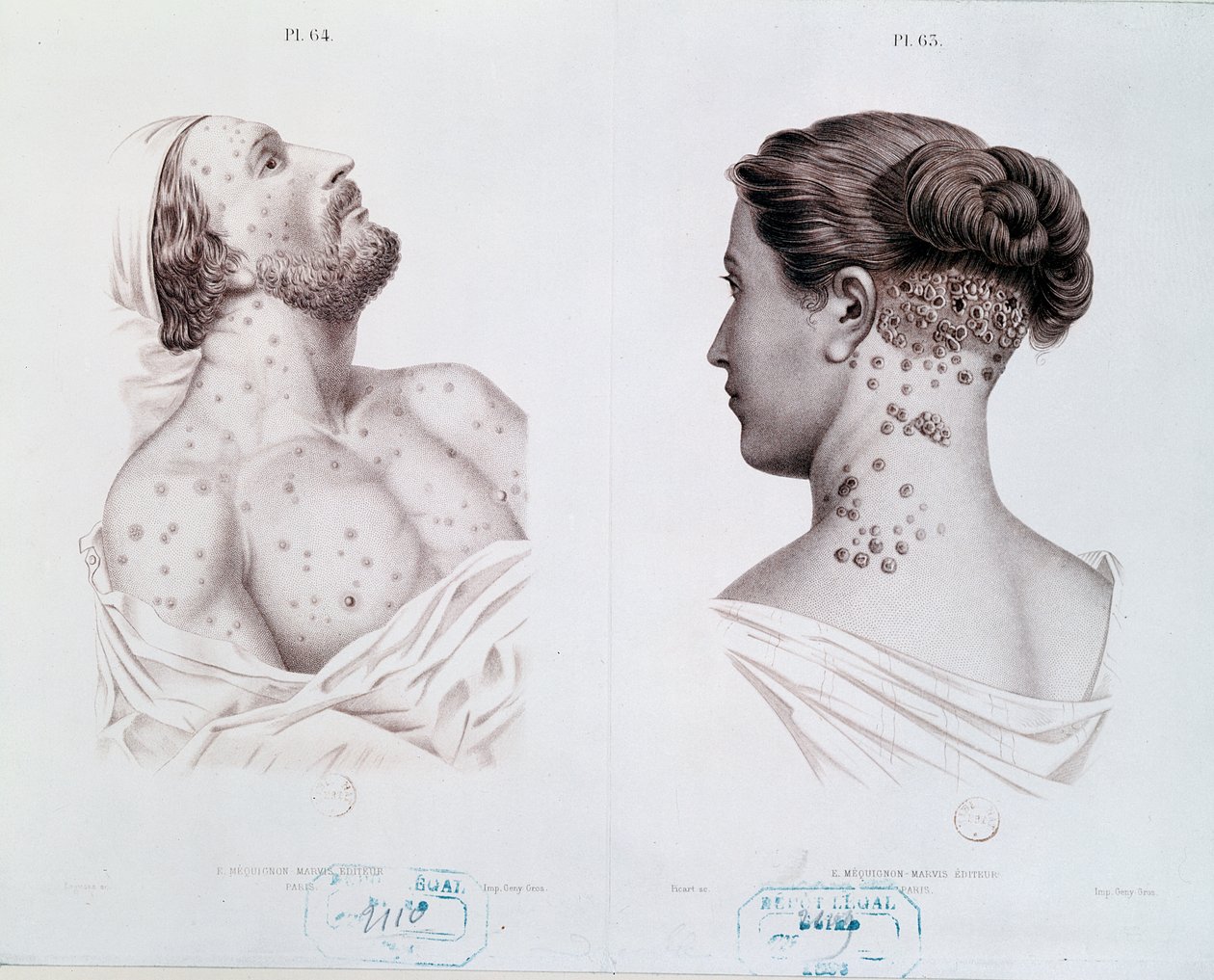 Symptomer på syfilis hos mænd og kvinder, fra en lægebog, ca. 1850-60 af French School