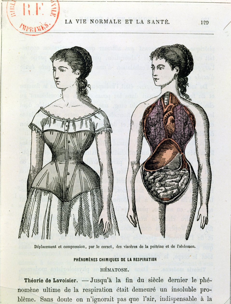 Korsettets skadelige virkninger, illustration fra La Vie Normale et la Sante af Dr. Jules Rengade (f.1841) ca. 1880 af French School