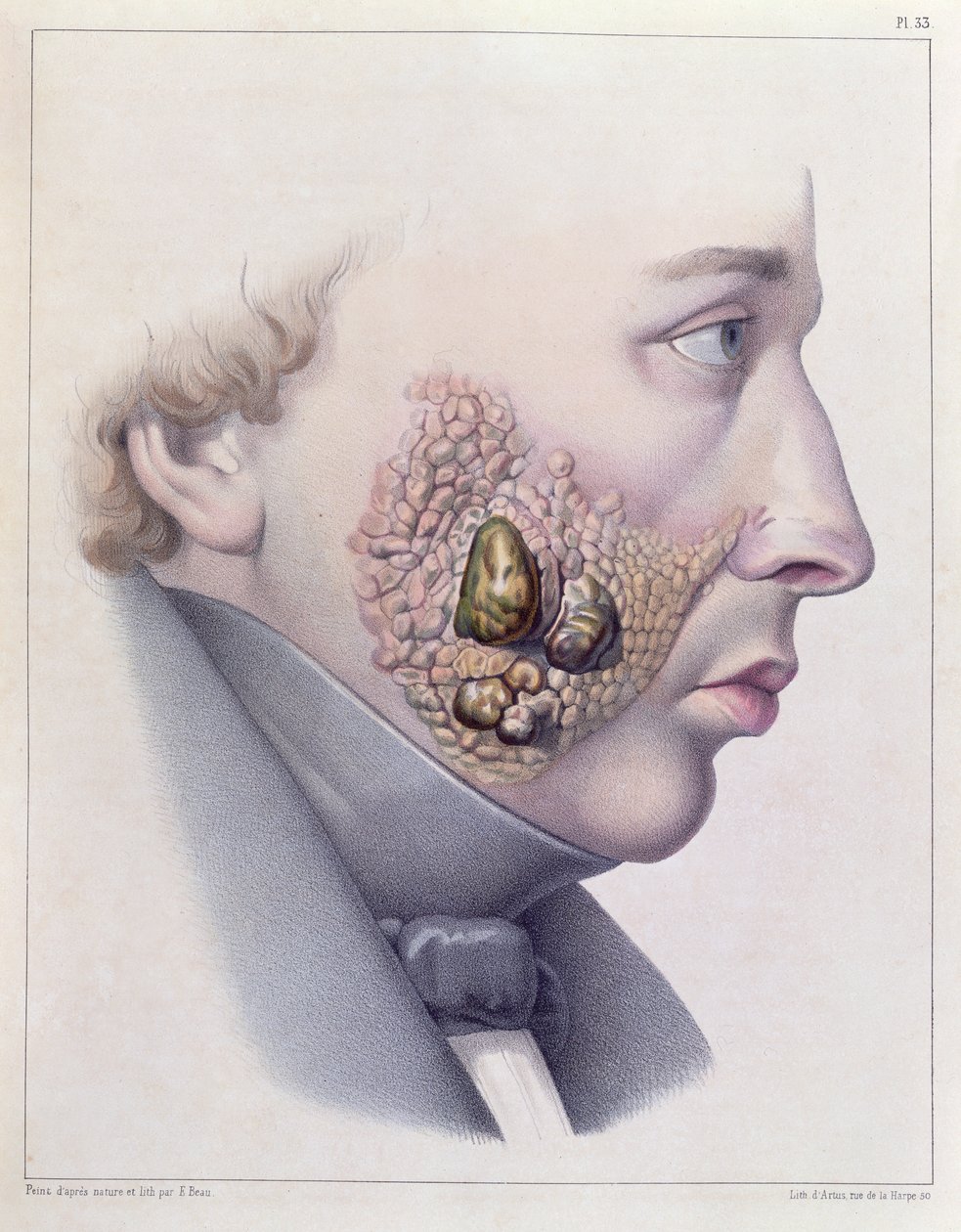 Ansigtssymptomer på kønssygdom, fra Traite Complet des Maladies Veneriennes af Philippe Ricord (1800-89) 1851 af French School