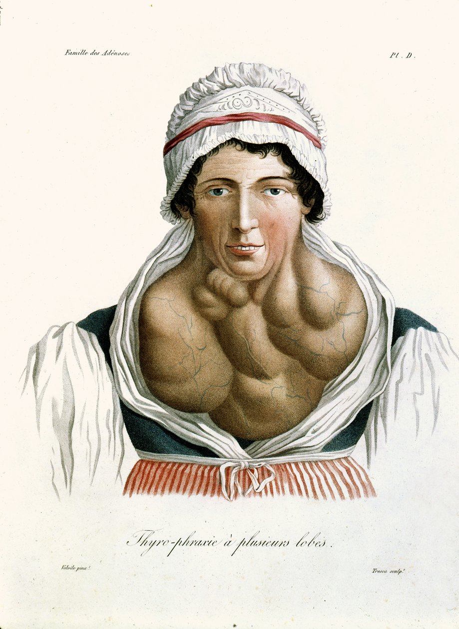 Skjoldbruskkirtelsygdom, fra en bog af Baron Jean Louis Alibert (1768-1837) 1817 af French School