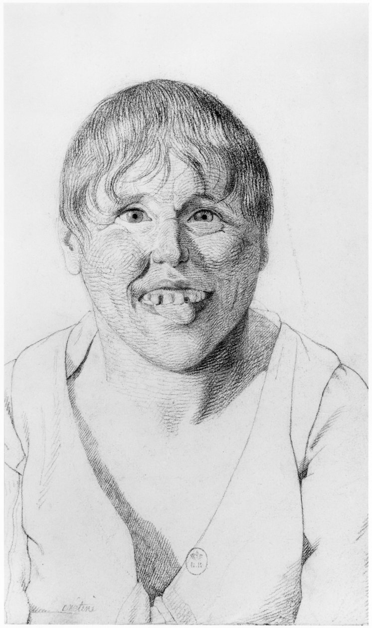 Cretin, set forfra, illustration fra en upubliceret afhandling af Jean Etienne Dominique Esquirol (1772-1840) om galningerne på Salpetriere-asylet, ca. 1818 af Georges Francois Gabriel