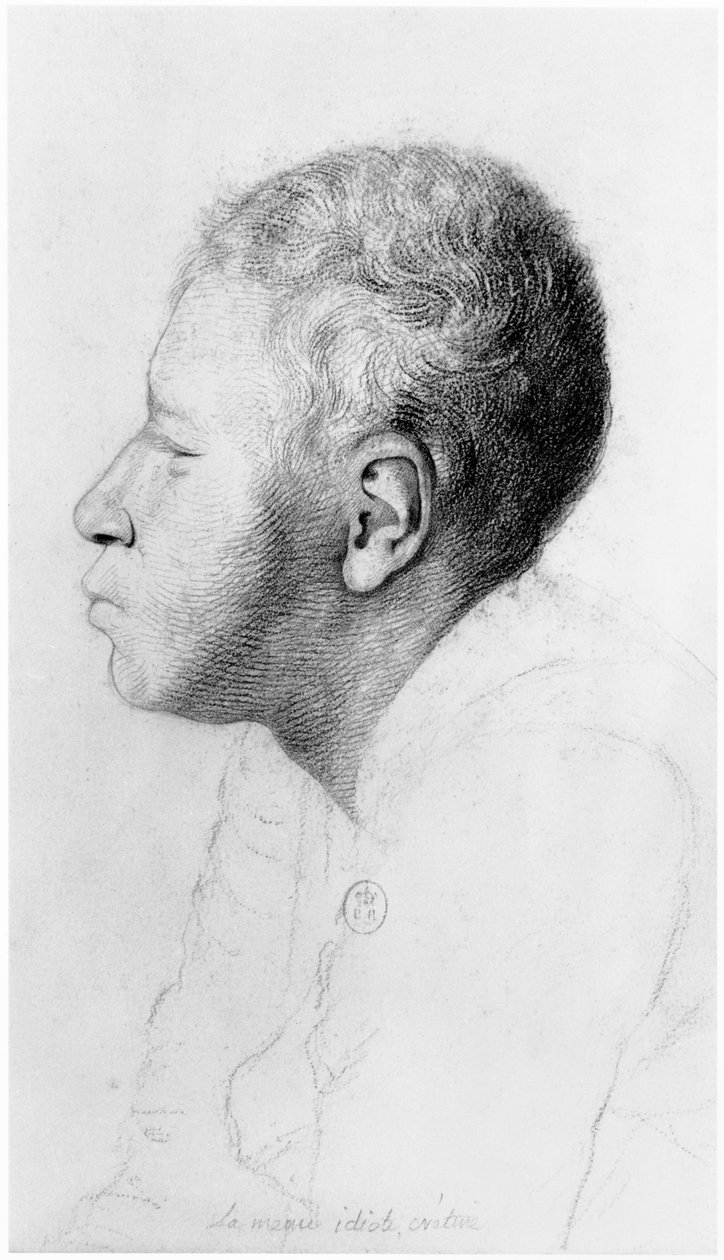 Cretin, profil, illustration fra en upubliceret afhandling af Jean Etienne Dominique Esquirol (1772-1840) om galningerne på Salpetriere-asylet, ca. 1818 af Georges Francois Gabriel