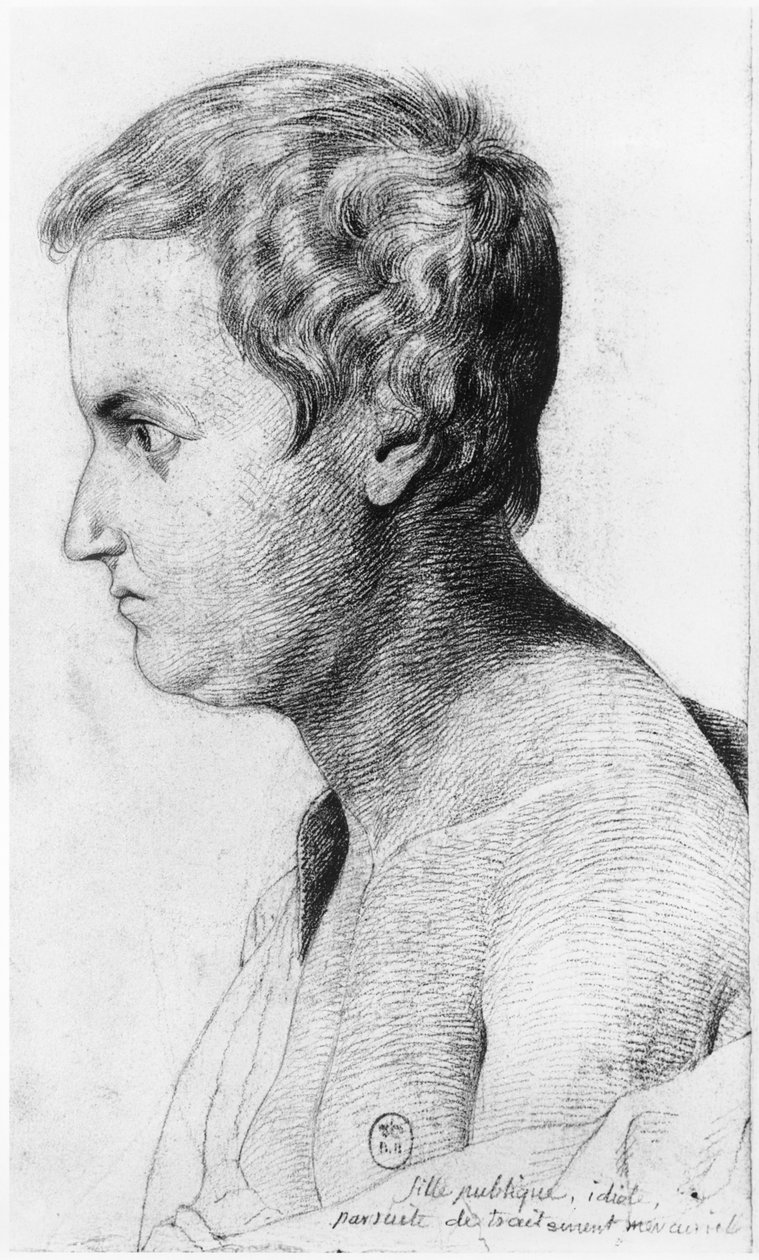 Idiotisk prostitueret, der lider af syfilis, illustration fra en upubliceret afhandling af Jean Etienne Dominique Esquirol (1772-1840) om galningerne på Salpetriere-asylet, ca. 1818 af Georges Francois Gabriel