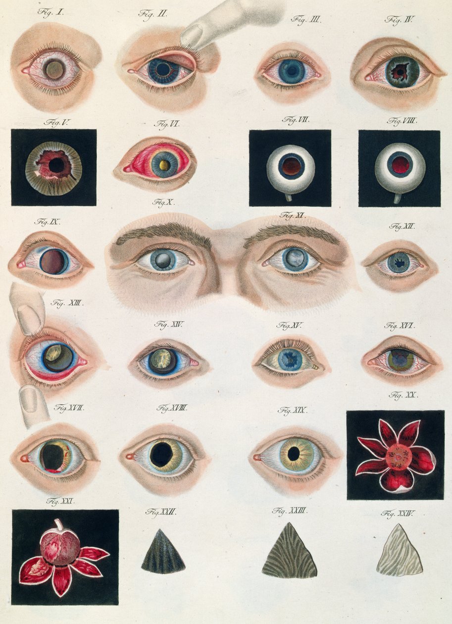 Beskrivelse af medfødte øjenanomalier, fra kliniske præsentationer af sygdomme og visuelle defekter i det menneskelige øje, af Friedrich August von Ammon (1799-1861) 1838 af German School