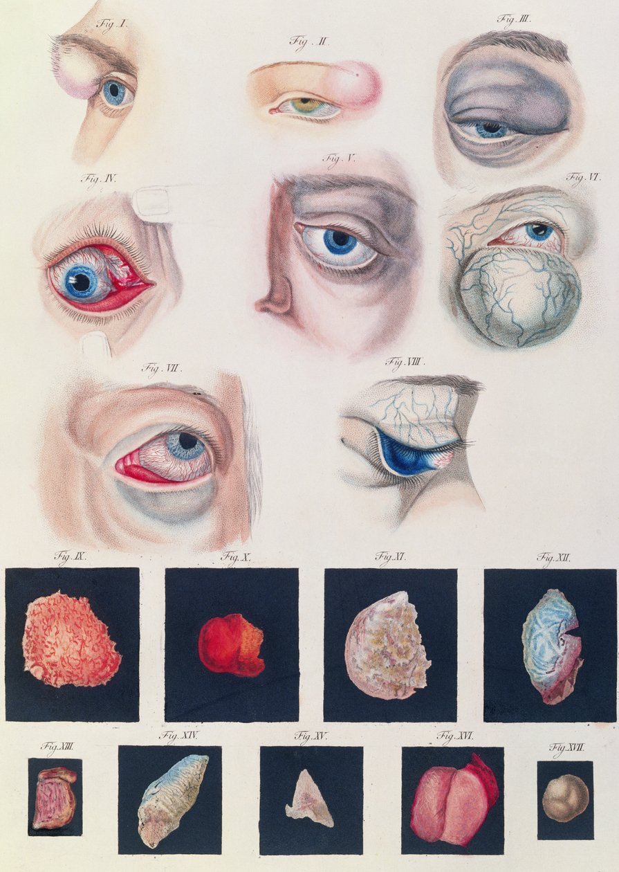 Beskrivelse af medfødte øjenanomalier, fra kliniske præsentationer af sygdomme og visuelle defekter i det menneskelige øje, af Friedrich August von Ammon (1799-1861) 1838 af German School