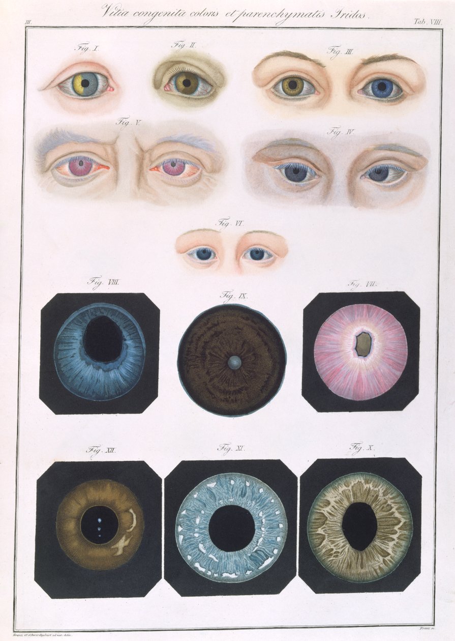 Beskrivelse af medfødte øjenanomalier, fra kliniske præsentationer af sygdomme og visuelle defekter i det menneskelige øje, af Friedrich August von Ammon (1799-1861) 1838 af German School