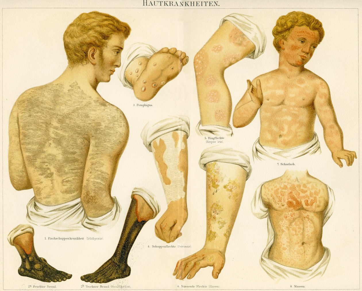 Hudlidelser, ca. 1890 af German School