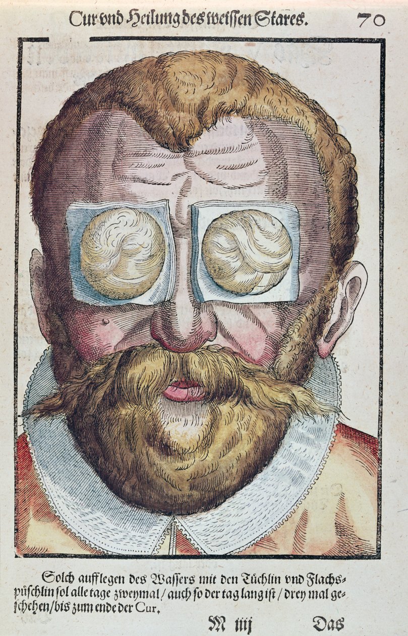 Behandling af en øjensygdom, fra Ophthalmodouleia af Georg Bartisch (1535-1636) udgivet i Dresden i 1583 (træblok i farver) af German School